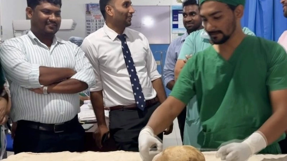 Chirurgen verwijderen blaassteen van 3,1 kilo in Sri Lanka, mogelijk een wereldrecord
