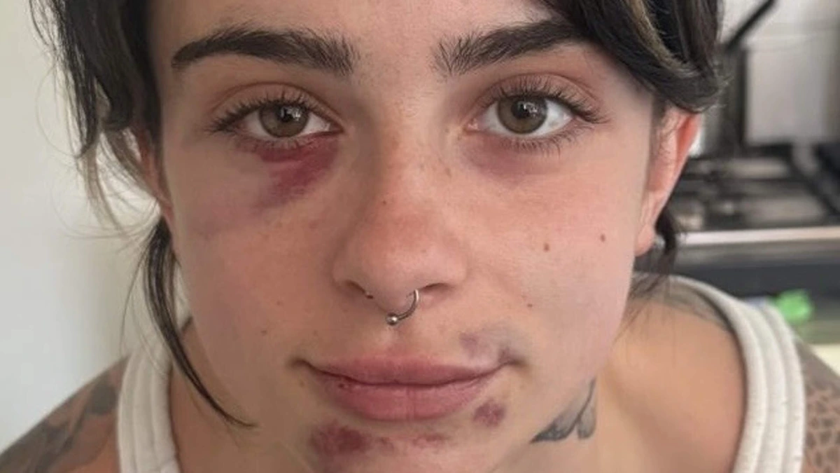 Lizzy (21) uit het niets zwaar mishandeld door getinte spierbundel: ’Hij stormde op me af en begon me in mijn gezicht te slaan’